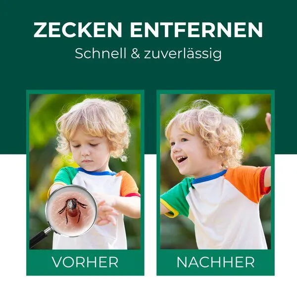 Silberkraft Silberkraft Zeckenzange Zeckenpinzette gegen Zecken – Produktbild 2 von 4